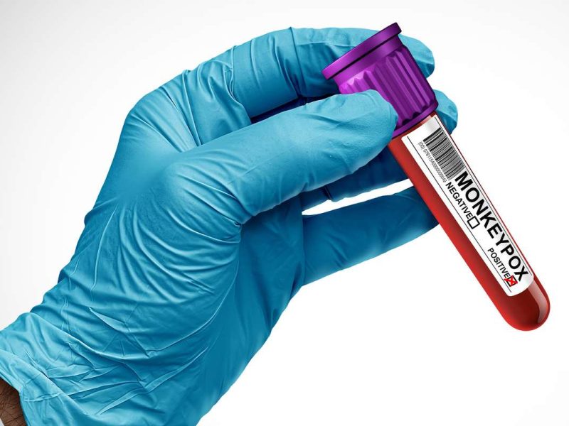 Suecia confirma primer caso de nueva variante de mpox fuera de África