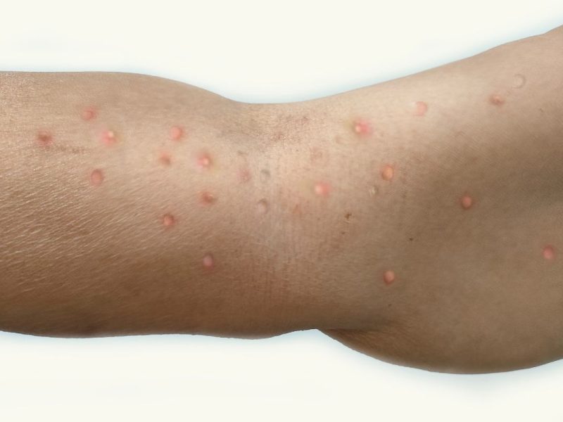 Qué es la viruela símica