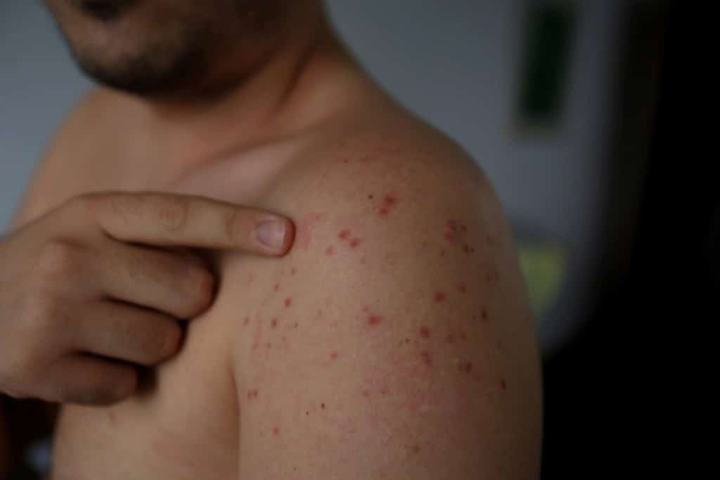 Contagios de Sarampión en cárcel de ICE