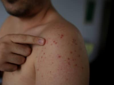 Contagios de Sarampión en cárcel de ICE