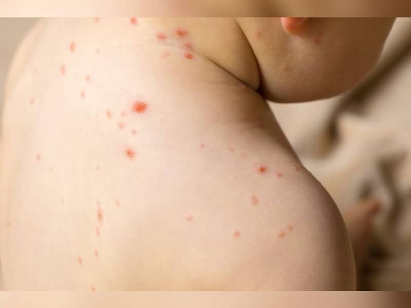 sarampión ya me vacuné